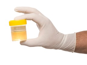 A close up of a doctors hand holding a sample jar.