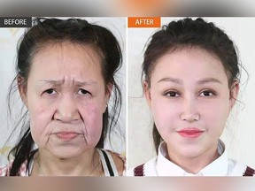 Photos from the Shenyang Sunline Plastic Surgery Hospital show what Xiao Feng looked like before and after her surgery. (Shenyang Sunline Plastic Surgery Hospital photos)
