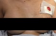 A Toronto woman narrowly escaped death when her breast implant deflected a bullet.