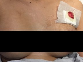 A Toronto woman narrowly escaped death when her breast implant deflected a bullet.
