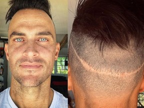 Actor Cheyenne Jackson revealed the scars on his scalp in a bid to avoid hair loss.