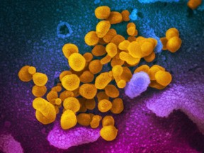 This undated electron microscope image made available by the U.S. National Institutes of Health in February 2020 shows the Novel Coronavirus SARS-CoV-2, yellow, emerging from the surface of cells, blue/pink, cultured in the lab. Also known as 2019-nCoV, the virus causes COVID-19.