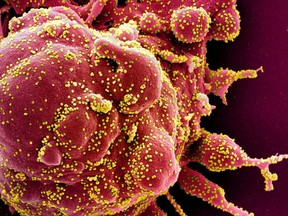 Colourized scanning electron micrograph of an apoptotic cell (red) infected with SARS-COV-2 virus particles (yellow), also known as novel coronavirus, isolated from a patient sample.