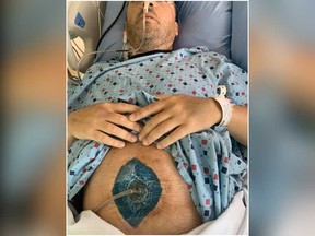 Shaun Mulldoon shared images of himself in a Facebook post detailing how he had six feet of his small intestine removed after developing a vaccine-induced blood clot in the organ.