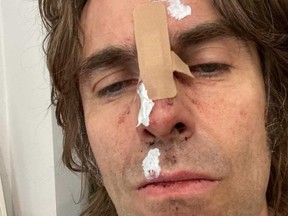 Liam Gallagher shared this image on Twitter after injuring his nose while getting out of a helicopter.