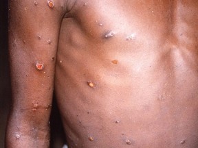 An image created during an investigation into an outbreak of monkeypox, which took place in the Democratic Republic of the Congo, 1996 to 1997, shows the arms and torso of a patient with skin lesions due to monkeypox, in this undated image obtained by Reuters on May 18, 2022.