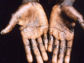 Die Handflächen eines Affenpockenpatienten aus Lodja, einer Stadt in der Katako-Kombe-Gesundheitszone, wurden 1997 während einer Gesundheitsuntersuchung in der Demokratischen Republik Kongo gesehen.