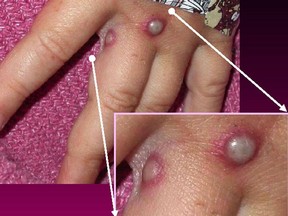 Photo released by the Centers for Disease Control and Prevention showing lesions caused by infection with the monkeypox virus.