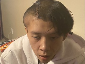 Pacey Dumas, 18, was hospitalized with a severe head injury on Dec. 9, 2020, which required doctors to remove a section of his skull. In a new lawsuit, Dumas and his family say the injury was caused by an Edmonton Police Service officer.