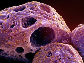 A study by Quebec's public health institute has found that between six and 10 per cent of the province's health-care workers have experienced long COVID. This colorized electron microscope image made available by the National Institute of Allergy and Infectious Diseases in November 2022, shows cells, indicated in purple, infected with the omicron strain of the SARS-CoV-2 virus, orange, isolated from a patient sample, captured at the NIAID Integrated Research Facility (IRF) in Fort Detrick, Md. THE CANADIAN PRESS/AP-HO, NIAID/NIH