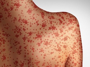 Alberta Health Services is warning of potential exposure to measles in public locations since Nov, 23.