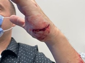 Air Canada pilot Connor Dubuc, 54, needed 14 stitches to close wounds on his left forearm and palm after he was attacked by a dog in Etobicoke on Tuesday, Nov. 7, 2023.