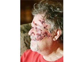 Assault victim Richard Suter in his home in southwest Edmonton on January 24, 2015. He was abducted from his home on the night of January 22, 2015, driven away in a vehicle, seriously assaulted, had his left thumb cut off and abandoned on the south side of the city.