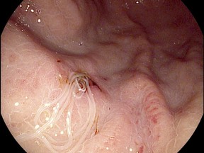 This image captured from an endoscope shows anisakis worms in a Calgary man's stomach after he prepared and ate raw sushi at home.