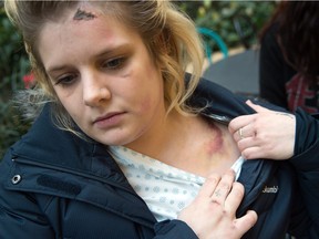 Zoey Zielinski, 21, displays some of the injuries she received when she was hit by a pickup on 153rd Avenue on Jan. 3. She managed to push the stroller holding her four-year-old daughter, Lynnaya, out of the way.