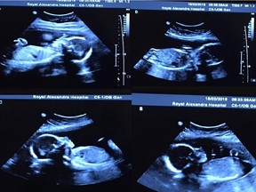 Tim and Bethani Webb were thrilled when they learned they were expecting a child shortly after getting married in northwestern Alberta last June. Since then they have discovered they are expecting identical quadruplets, a 1 in 67 million occurrence. An ultrasound of the quadruplets is shown in a handout photo.