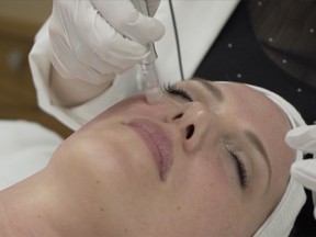 Micro-needling delivers 150 micro-perforations per second, initiating a healing cascade, stimulating collagen and elastin production to create more full, even skin.