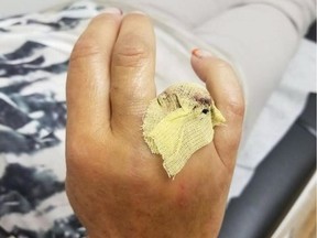 Claire Clark's hand is shown after an amputation following an accident at the West Edmonton Mall waterslide, in this recent handout photo.