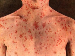 Alberta Health Services alerted the public on Monday, May 20, 2019, that an adult with a case of the measles may have exposed others.