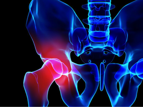 Centric Health Surgical Centre Toronto uses the direct anterior approach for total hip replacements, which results in quicker recovery and less post-op pain compared to traditional hip replacement methods.
