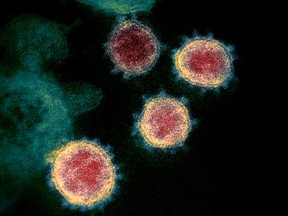 This undated electron microscope image made available by the U.S. National Institutes of Health in February 2020 shows the virus that causes COVID-19. The province reported 96 new cases of COVID-19 and one additional death in southern Alberta on Sunday, according to the latest update by Alberta Health.