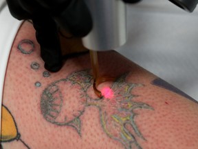 Laser removing a tattoo