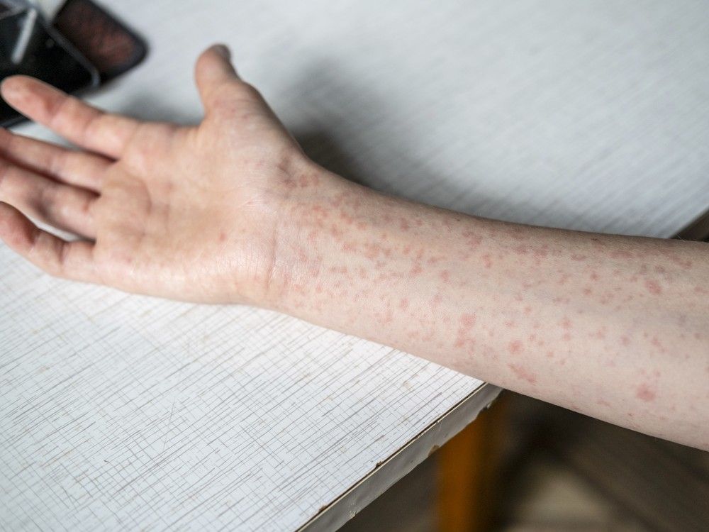 As measles cases in Alberta rise to 1,020, AHS issues bulletin over possible contacts at the Stollery Children's Hospital