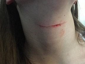 The wound received by the 16-year-old daughter of Okotoks' Stacey Bond, who said she was attacked by a knife wielding suspect at her Cimmaron Vista home on Nov. 18, 2017. RCMP are investigating. Facebook photo