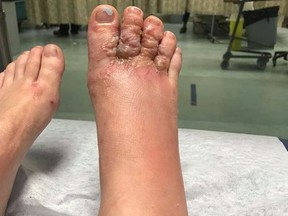 The infected foot of Katie Stephens is shown in this undated handout photo taken from Facebook. The experience of a Windsor, Ont., couple who returned from a Caribbean vacation with their feet severely infected with parasitic worms is a cautionary tale of what travellers to some warm-weather destinations might encounter ??? and how they might avoid a similar fate, says a tropical medicine specialist. Dr. Jay Keystone, a physician in the tropical disease unit at Toronto General Hospital, said cases of the hookworm-related skin infection that afflicted Katie Stephens and Eddie Zytner on a recent trip to the Dominican Republic are not that uncommon among travellers to countries in the developing world.