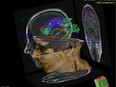 A diffusion tensor MRI scan of a study volunteer used to see if there are any abnormal connections in white matter tracts as a result of perimenopausal depression.