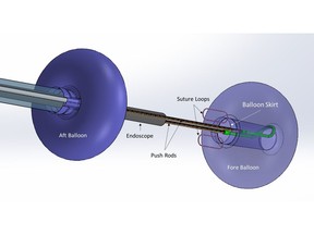 New DiLumen™ EIP technology with 'suture loops' placed in the skirt along the trailing edge of the fore balloon will help facilitate tissue manipulation for easier dissection and resection of polyps without the need for surgical intervention.