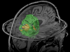 MDNA55 covering the rGBM tumour and surrounding margins where relapse is likely to occur.