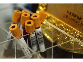 Patients' blood sits in vials at Ruijin Hospital's center for functional neurosurgery in Shanghai, China on Monday, Oct. 29, 2018. Western attempts to push forward with human trials of deep brain stimulation, or DBS, for drug addiction have foundered, even as China emerges as a hub for this kind of research. But rising opioid-related deaths may be changing that. The first U.S. trial of DBS for opioid addiction could begin in West Virginia as early as June.