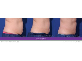 Before and After with truSculpt® iD Body Sculpting Technology