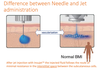 The difference between a needle application vs. going needle-free.