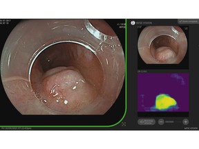 Provided by Professor Pradeep Bhandari: "Once the neoplasia is found, the system takes a still image and transfers it to the top right corner of a screen as a reference image for endoscopists. It also has a heat map which shows the area of the AI-predicted neoplasia."