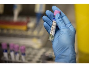 A medical laboratory technician shows a suspected monkeypox sample at the microbiology laboratory of La Paz Hospital in Madrid. Photographer: Pablo Blazquez Dominguez/Getty Images