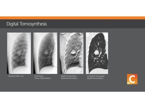 Carestream Health is partnering with Robarts Research to demonstrate the clinical value of digital tomosynthesis and dual energy technologies to help improve patient outcomes.