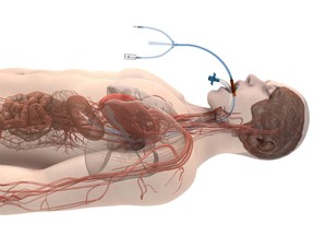 Attune Medical has been granted De Novo marketing authorization from the US Food and Drug Administration (FDA) for its ensoETM device to reduce the likelihood of ablation-related esophageal injury resulting from radiofrequency cardiac ablation procedures. The ensoETM is the pioneer of using the esophageal space to manage temperature and has been cleared for use for the control of patient temperature since 2015. Over 50,000 patients have been treated with the ensoETM to date in critical care units, emergency rooms, operating rooms, and electrophysiology labs.