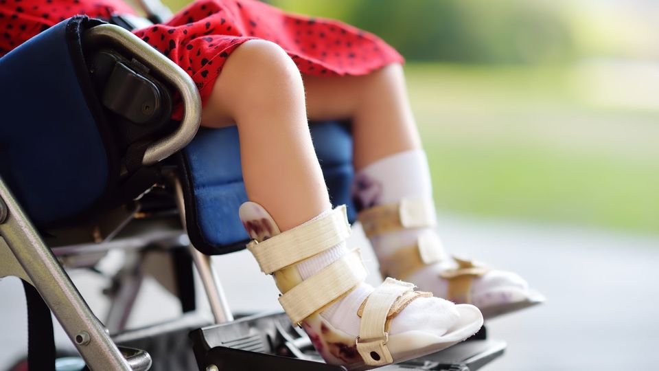 In the past, clinics have diagnosed CP in children with muscle tightness or developmental delay. cerebral palsy girl
