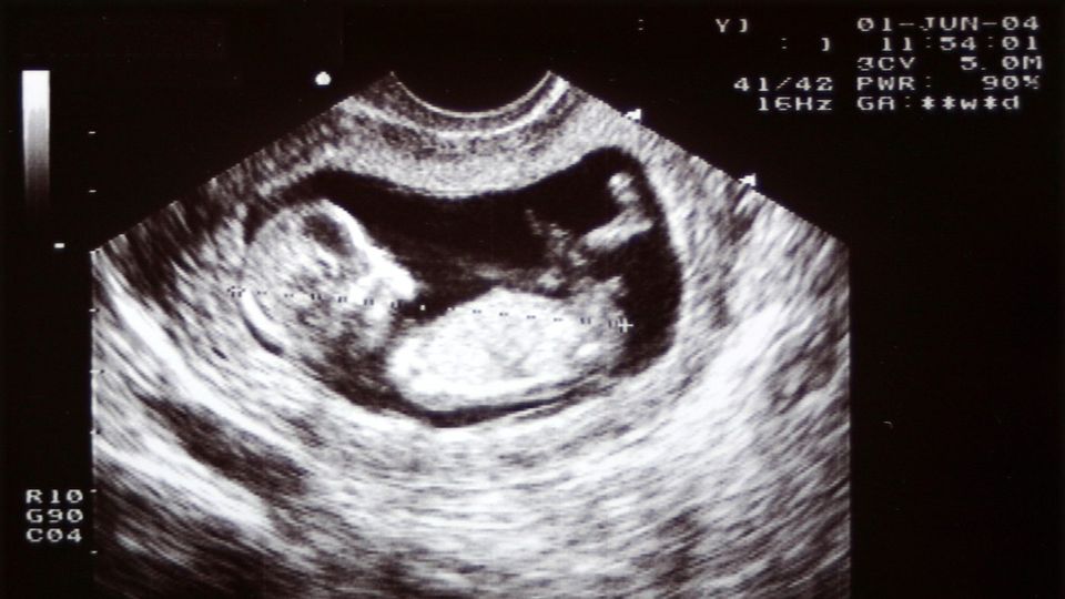 Ultrasound, 12 weeks old