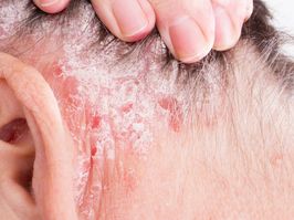 psoriasis behind the ear