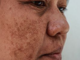Skin problem, Closeup skin face asian women with spot melasma.