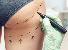 plastic surgeon marking womans body for plastic surgery