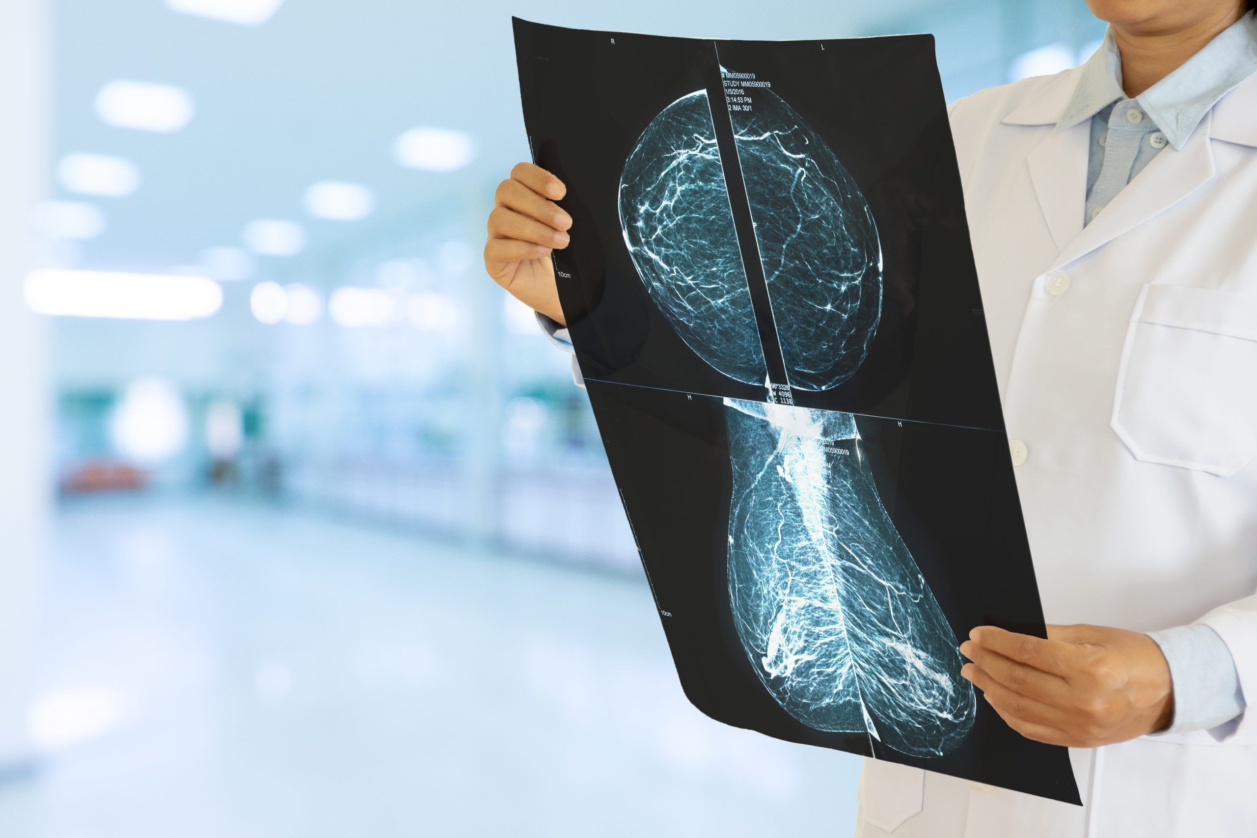 x-ray of breast