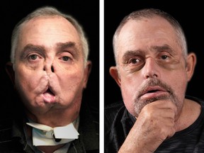 Before and after photos of Maurice Desjardins, recipient of Canada's first face transplant. Courtesy Dr. Daniel Borsuk.