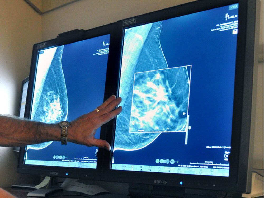 A Quebec researcher who co-authored the study noted that one out of six breast cancers is diagnosed in women younger than 50. He suggested that if the saliva test could be given to women starting in their 40s, it could pick up those cases.