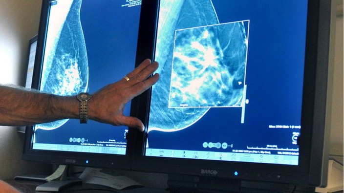 Simple saliva test could predict breast-cancer risk: study