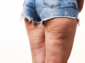 woman with cellulite on thighs