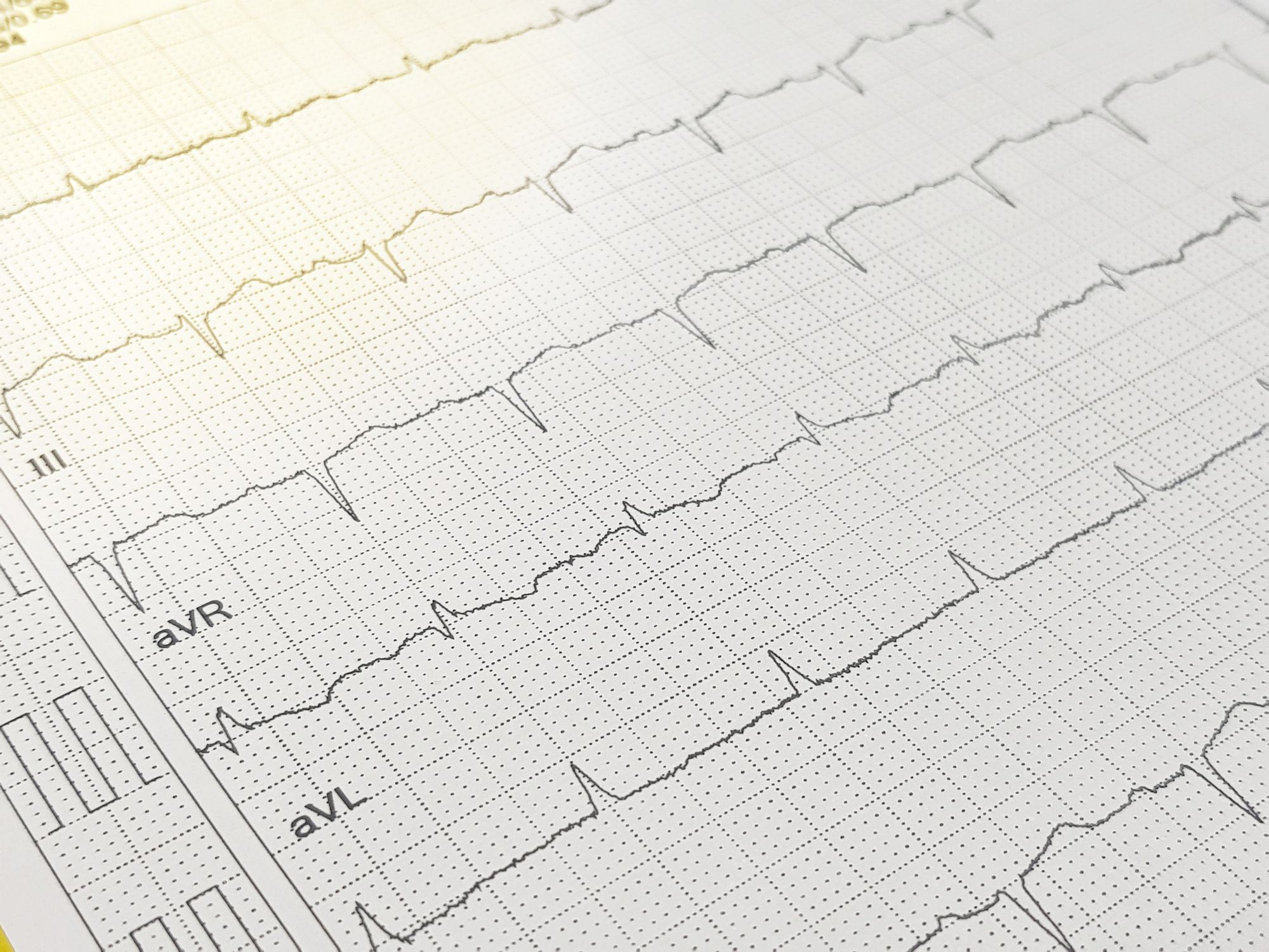 a sheet of abnormal electrocardiography, ecg, atrial fribillation